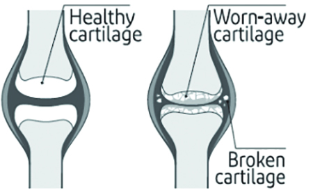 OA Cartilage