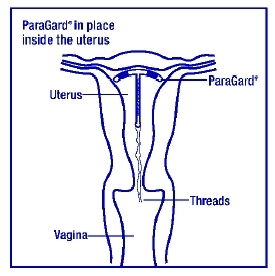 Illustration of ParaGard in correctly placed in the uterus