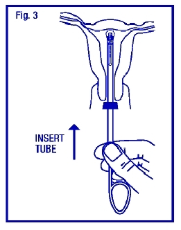 Illustration of passing the loaded insertion tube through the cervical os