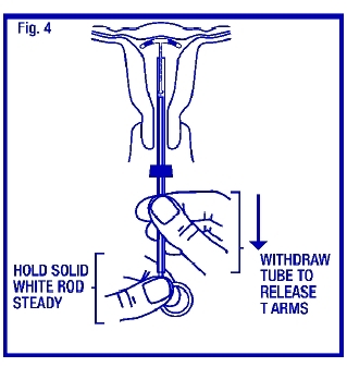 Illustration of releasing the ParaGard near the uterine fundus
