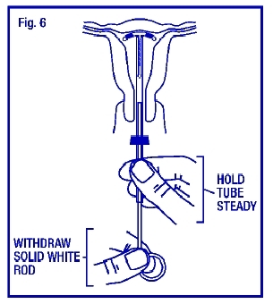 Illustration of withdrawing the rod
