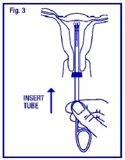 Grasp the insertion tube at the open end of the package; adjust the blue flange so that the distance from the top of the ParaGard® (where it protrudes from the inserter) to the blue flange is the same as the uterine depth that you measured with the sound. Rotate the insertion tube so that the horizontal arms of the T and the long axis of the blue flange lie in the same horizontal plane (Fig. 3). Now pass the loaded insertion tube through the cervical canal until ParaGard® just touches the fundus of the uterus. The blue flange should be at the cervix in the horizontal plane.