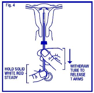 To release the arms of ParaGard®, hold the solid white rod steady and withdraw the insertion tube no more than one centimeter. This releases the arms of ParaGard® high in the uterine fundus (Fig. 4).