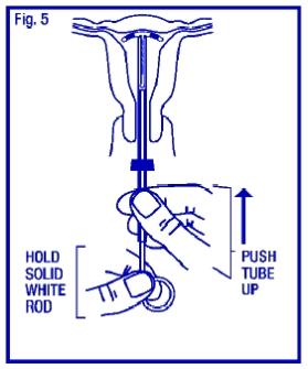 Gently and carefully move the insertion tube upward toward the top of the uterus, until slight resistance is felt. This will ensure placement of the T at the highest possible position within the uterus (Fig. 5).