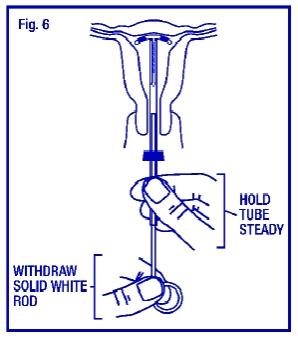 Hold the insertion tube steady and withdraw the solid white rod (Fig. 6).