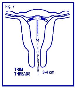 Gently and slowly withdraw the insertion tube from the cervical canal. Only the threads should be visible protruding from the cervix. (Fig. 7). Trim the threads so that 3 to 4 cm protrude into the vagina. Note the length of the threads in the patient’s records.
