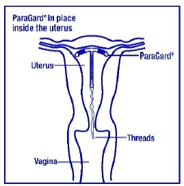 ParaGard® is placed in your uterus during an office visit. Your healthcare provider first examines you to find the position of your uterus. Next, he or she will cleanse your vagina and cervix, measure your uterus, and then slide a plastic tube containing ParaGard® into your uterus. The tube is removed, leaving ParaGard® inside your uterus. Two white threads extend into your vagina. The threads are trimmed so they are just long enough for you to feel with your fingers when doing a self-check. As ParaGard® goes in, you may feel cramping or pinching. Some women feel faint, nauseated, or dizzy for a few minutes afterwards. Your healthcare provider may ask you to lie down for a while and to get up slowly.