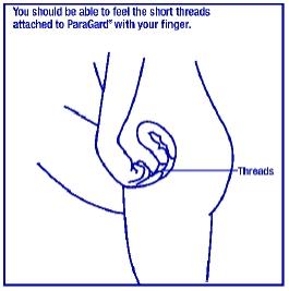 You can also check to make sure that ParaGard® is still in your uterus by reaching up to the top of your vagina with clean fingers to feel the two threads. Do not pull on the threads. 