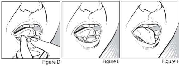 As soon as you remove your prescribed dose of ZUBSOLV from the blister pack place the tablet under your tongue (See Figures D, E, and F). If more than 1 tablet is required, place the tablets in different places under your tongue at the same time.