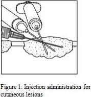 Figure 1: Injection administration for cutaneous lesions