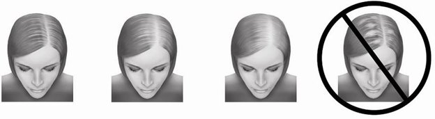 hair loss image