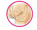 Place the tip of the ring in the vaginal opening. Use your index finger to push the folded ring gently into your vagina. Push it up towards your lower back as far as you can (See Figure E).