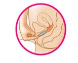 If the ring feels uncomfortable, you may not have pushed the ring into your vagina far enough. Use your index finger to push the ring as far as you can into your vagina (See Figure F). 